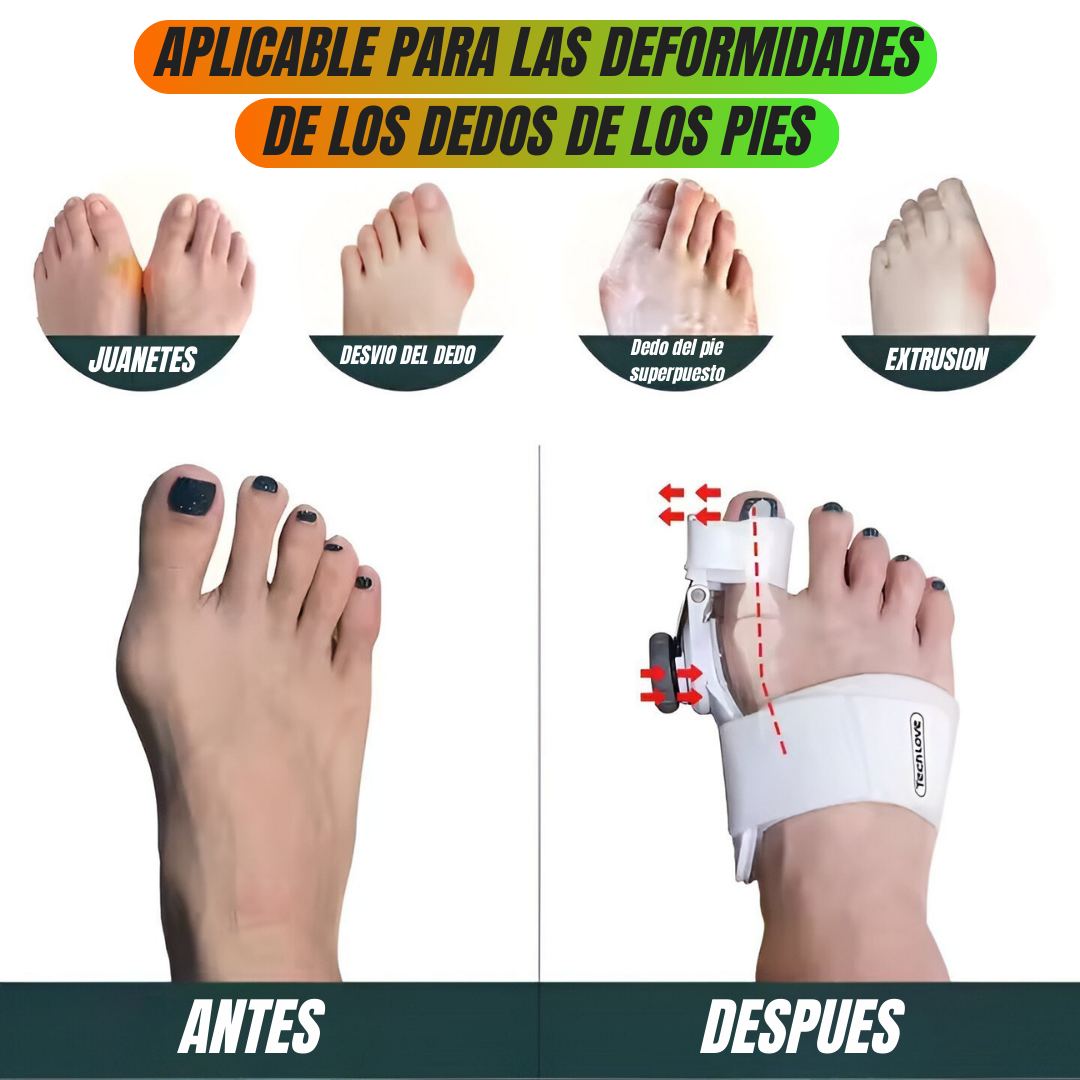 ✨ ¡Lleva tu Corrector Ortopédico para Juanetes por solo Q199 y recibe REGALOS EXCLUSIVOS + ENVÍO GRATIS! ✨